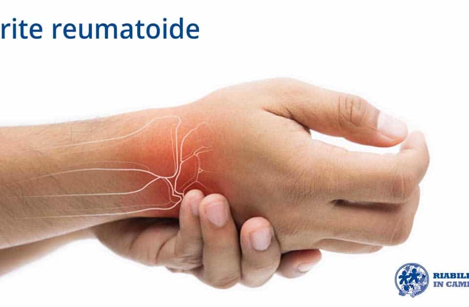 artrite riabilitazione campania