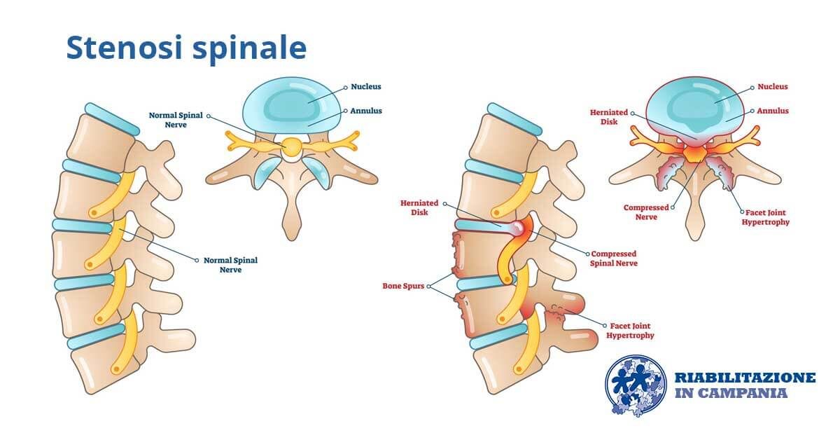 immagine rappresentativa lastenosi spinale riabilitazione campania