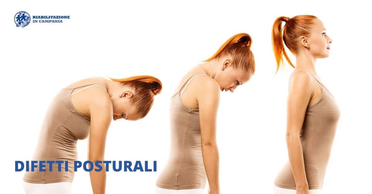 Difetti posturali - Riabilitazione campania