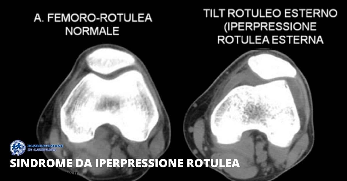 fisioterapia per sindrome Iperpressione rotulea napoli